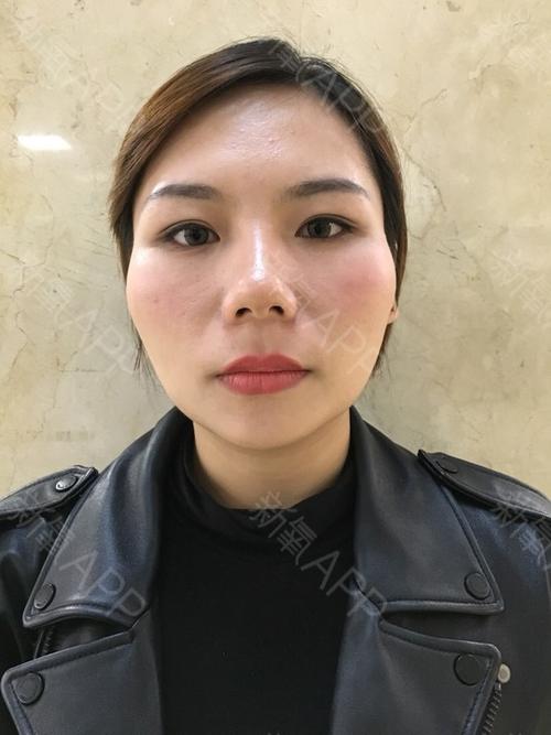 颧骨颧弓整形术