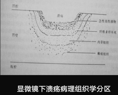 其它 溃疡知识知多少 写美篇病理 十二指肠溃疡好发于球部,前壁较常见