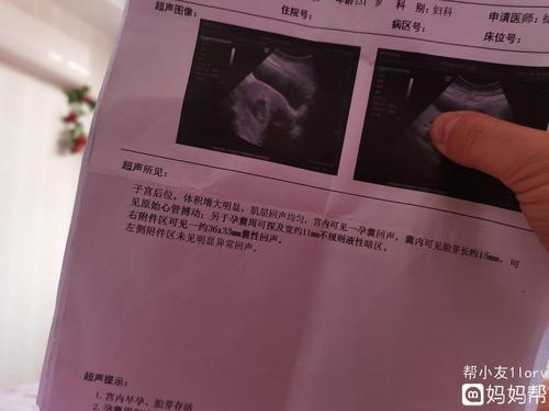 孕8周零2天,都说这个时候孕囊看男孩女孩