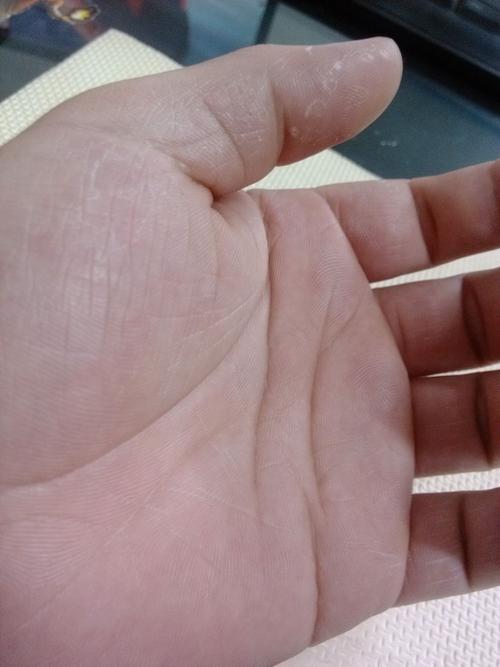 手指脱皮