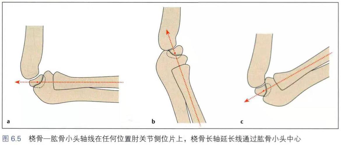儿童创伤警惕漏诊儿童孟氏骨折monteggia