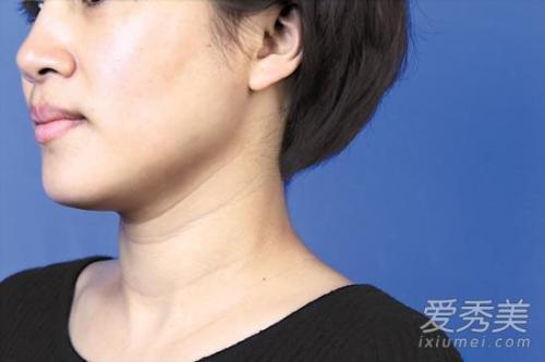 脖子有颈纹的女人面相