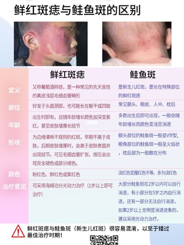 有一种红胎记可能会误以为是鲜红斑痣6315_鲑鱼_新生儿_鲜红斑痣