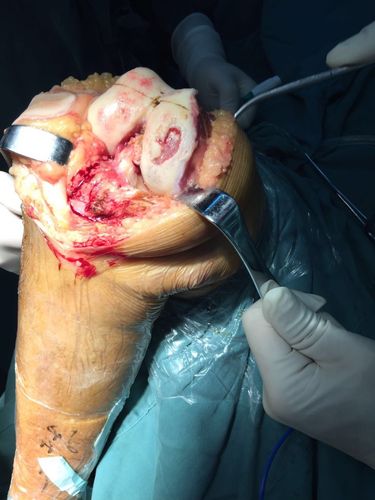 全膝关节置换在内翻膝的应用. 骨一徐荣敏