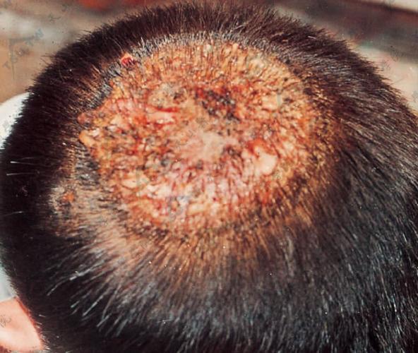 头癣(黄,白,黑)诊疗参考:真菌感染头皮毛发所致