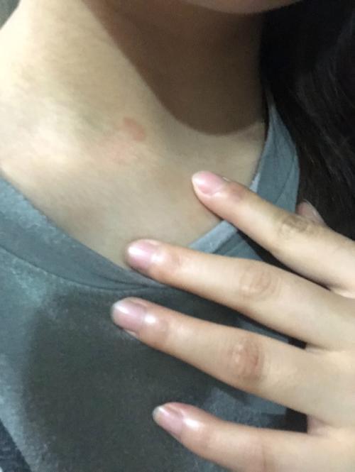 脖子上长了红色的圆圈