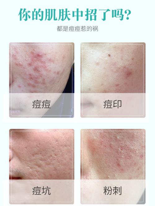 海洋诗韵祛痘套装祛痘印痘疤修复淡化去痘印痘疤凹洞痘坑三件套_7折