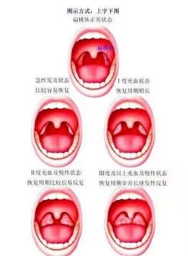 什么是腺样体肥大和扁桃体肥大?