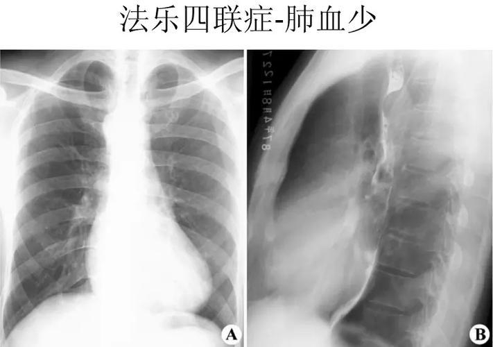 心脏x线表现