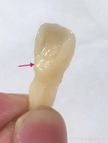 中国人或者说东亚人的前牙的舌隆突不明显