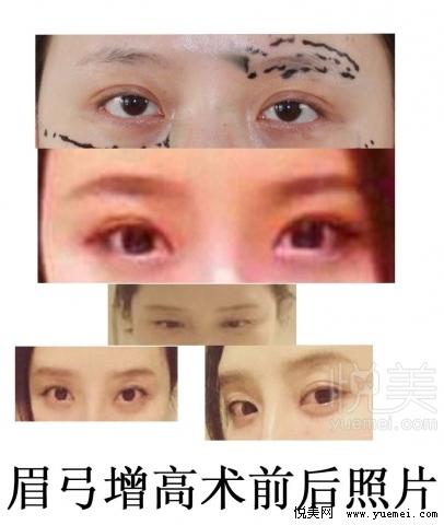 眉弓增高术前后对比照片