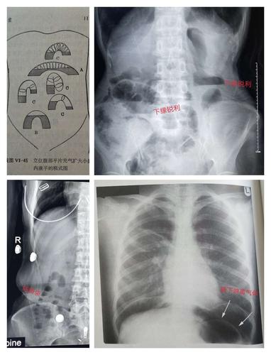 肠梗阻的征象为腹部三个及以上高低不等呈阶梯状排列的气液平