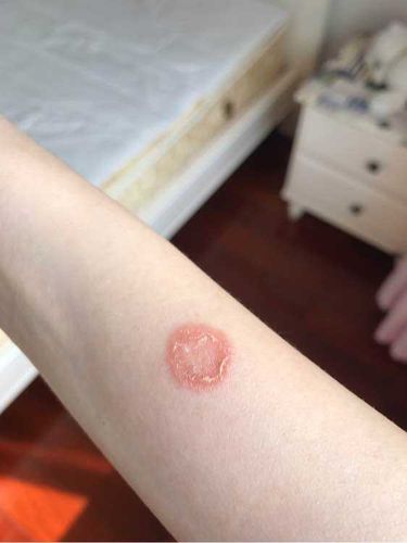 十年临床猫医生100治猫癣的建议