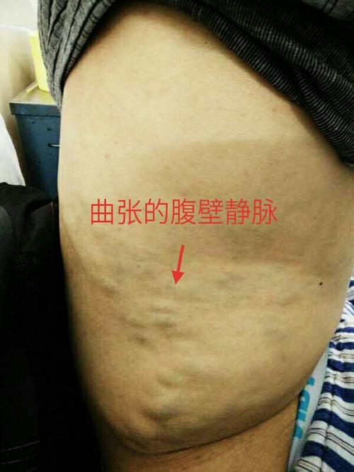 当"静脉曲张"遇上了"肝硬化",需高度怀疑"布加"!