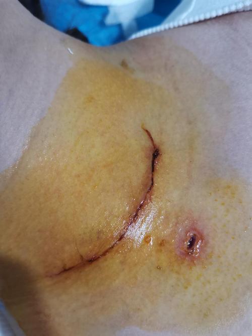 伤口还是有点吓人哈,下面的小洞是手术插的引流管.