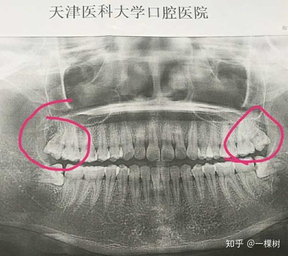5年前拔完四颗智齿现在脸部下垂导致脸型都变了请问是不是和拔智齿有