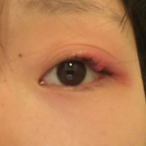睫毛根部长了疙瘩 然后很痛 我就涂了红霉素眼膏,涂了俩天确实不怎么