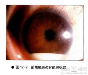 如何防止葡萄膜炎复发