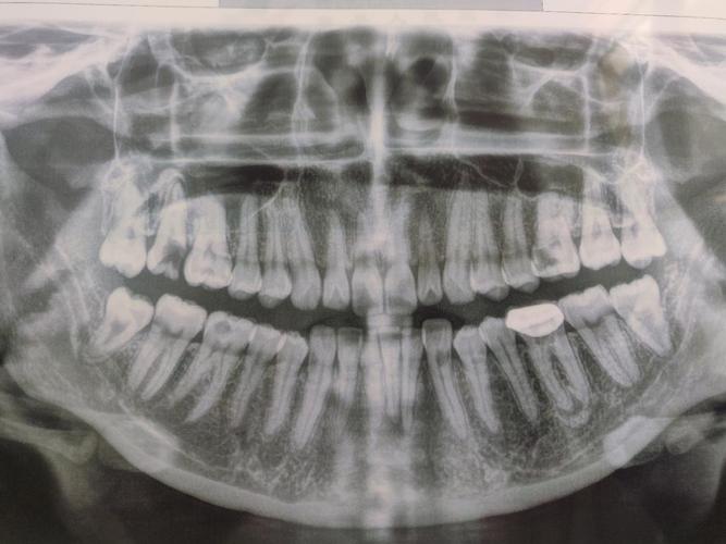 智齿发炎拍了牙片…感觉人生从此转折_(:з」∠)