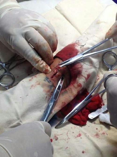 腕部腱鞘囊肿手术全过程