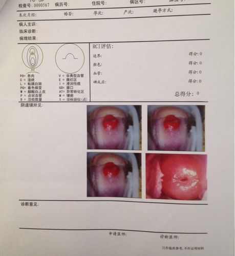 宫颈糜烂,子宫后位能生吗?