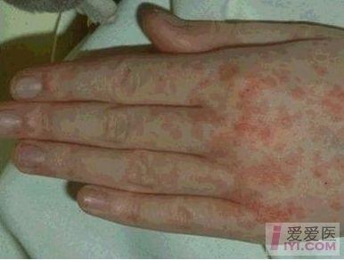 儿科常见出疹子类疾病图片 - 门头沟区中小学卫生保健所 - 校医之家