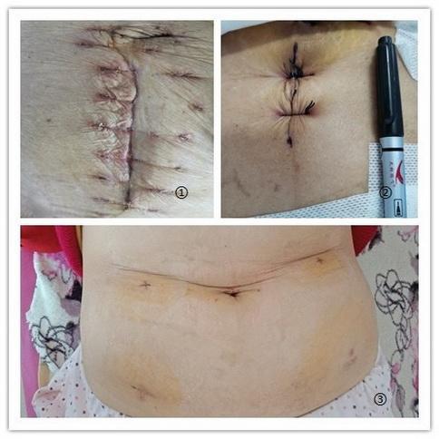 全市首例|德州市人民医院胃肠外科成功独立开展经自然