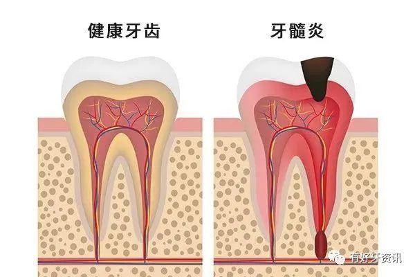 解读什么是急性牙髓炎