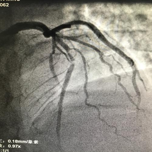前降支中段两处病变狭窄60-90%.