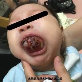 这个两个月大的小宝宝嘴巴恢复正常,罪魁祸首原来是是巨大血管畸形