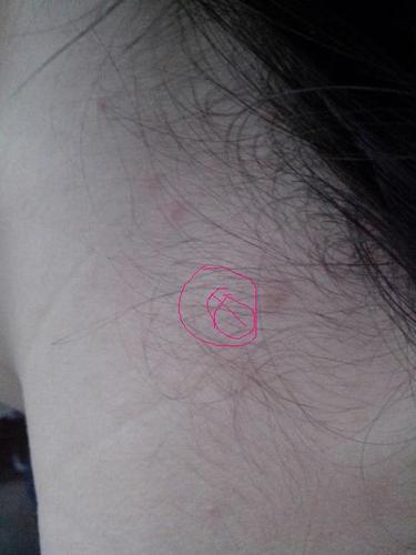 脖子侧面里面张了一个硬硬的疙瘩,侧着脖子