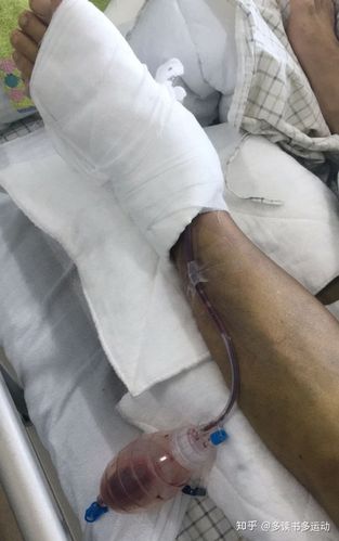 跟骨粉碎性骨折手术前后二楼踩空很严重
