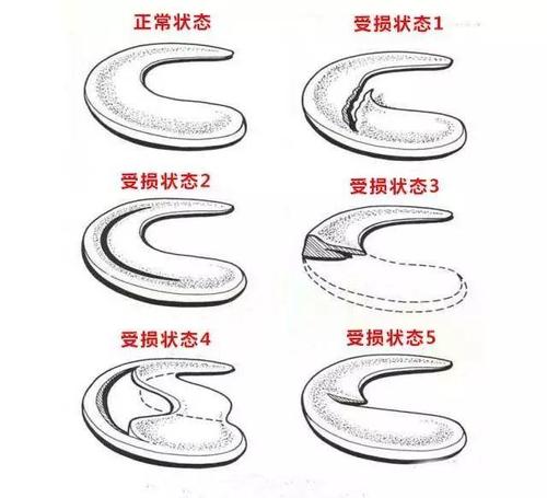 半月板损伤后要不要手术?