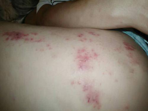 好几天了.不知道是不是干疮子还是过敏