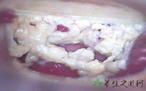 霉菌性阴道炎症状_女性保健_养生人群_养生之道网