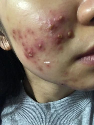 痘痘,痤疮7515慎入7515100天抗痘全过程#_痘痘_痤疮_药膏