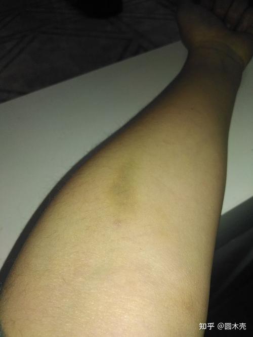 为什么抽血后,胳膊会变青?