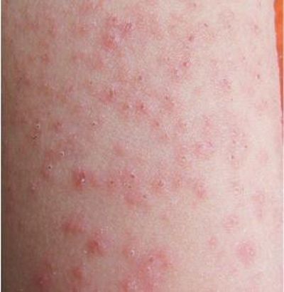 荨麻疹病早期症状有哪些