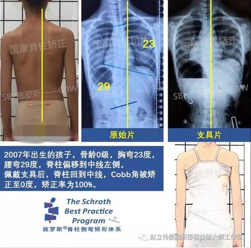 施罗斯脊柱侧弯矫形体系-脊柱侧弯女孩,穿上gbw支具后