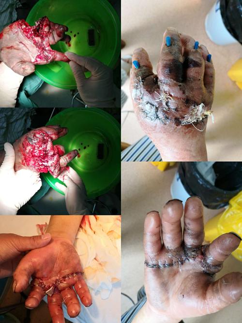 手指(足趾,四肢)离断再植