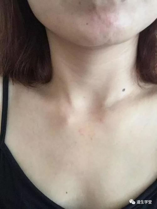 李氏砭法|砭治误诊锁骨软骨炎