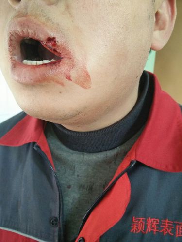 19号,我被人殴打,口腔打了个大洞后来去立案警察说