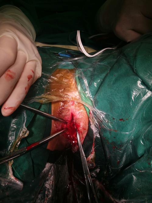 一天三台不同尿道手术