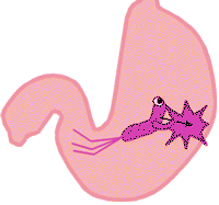 活谓素:胃溃疡患者饮食需要注意哪几点?