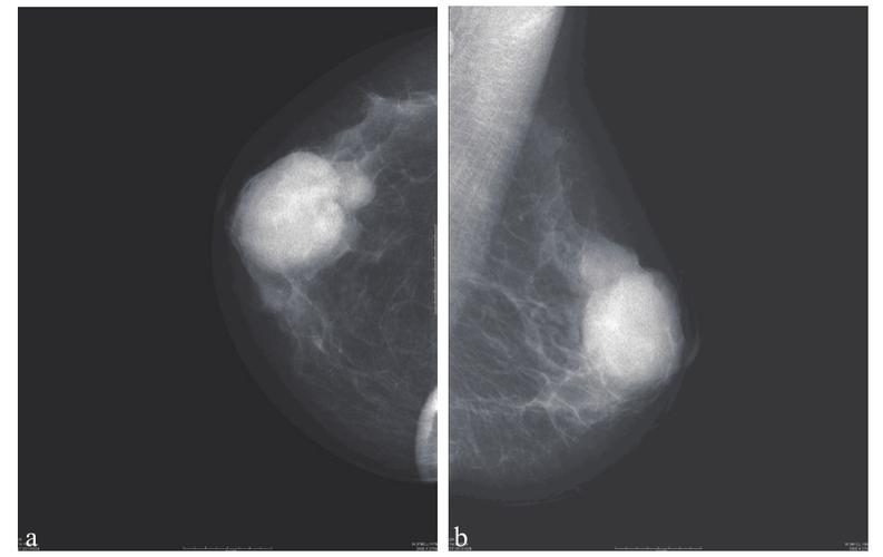 乳腺导管扩张症的x线误诊分析