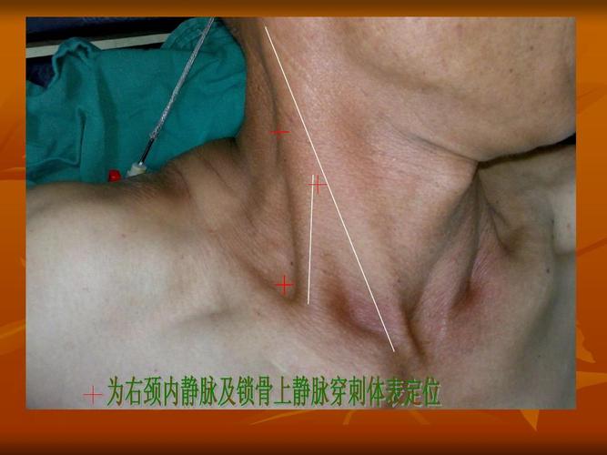深静脉置管术ppt
