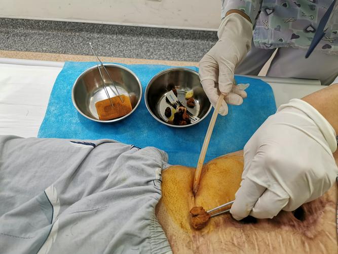 膀胱造瘘术后的护理及注意事项