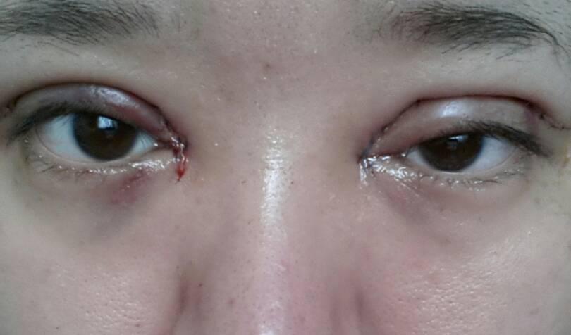 问:昨天刚做的全切加开眼角,今天起来摘下纱布发现左眼很肿.
