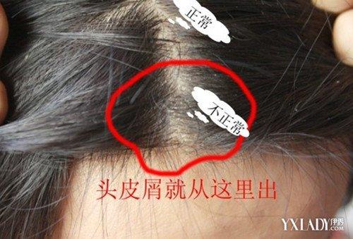 【图】头皮癣图片大全 头皮癣三种常规治疗方法介绍