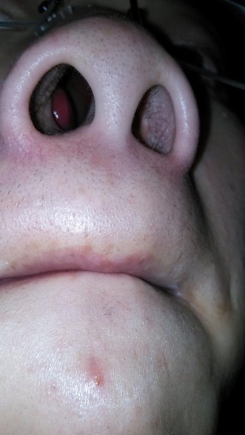 鼻子里面有一个瘤状物,拜托给看下是什么情况